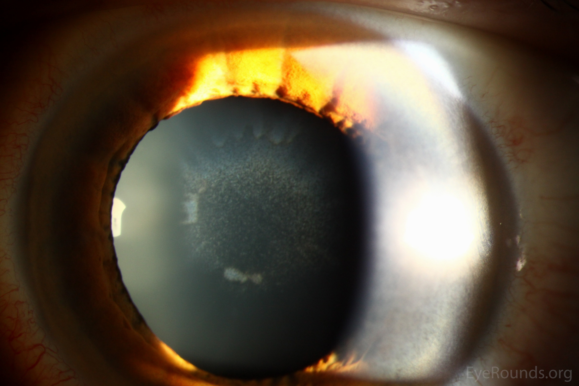  Slit lamp photographs of sunflower cataracts of the left eye