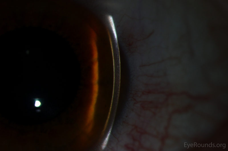 KayserFleischer Ring in Wilson's Disease