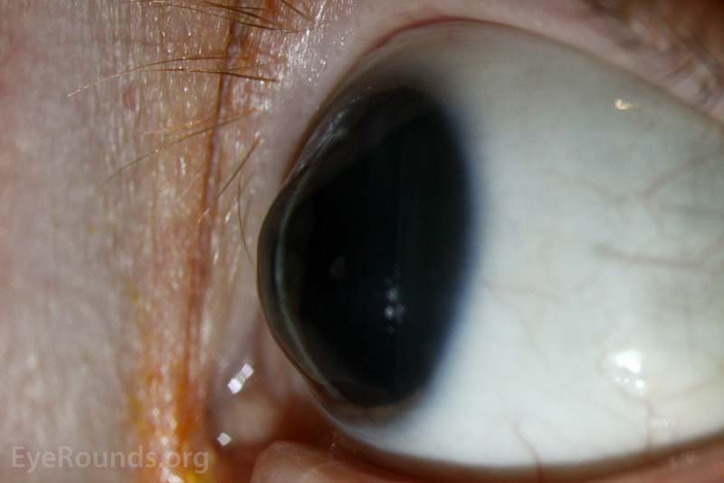 Keratoconus