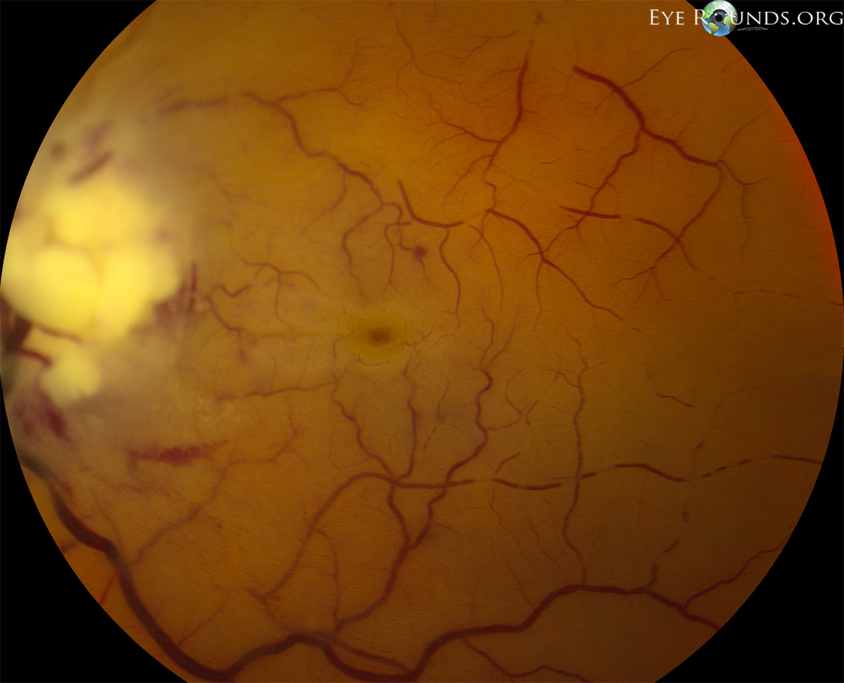 Lymphomatous infiltration of left optic nerve with central retinal artery occlusion fundus photo