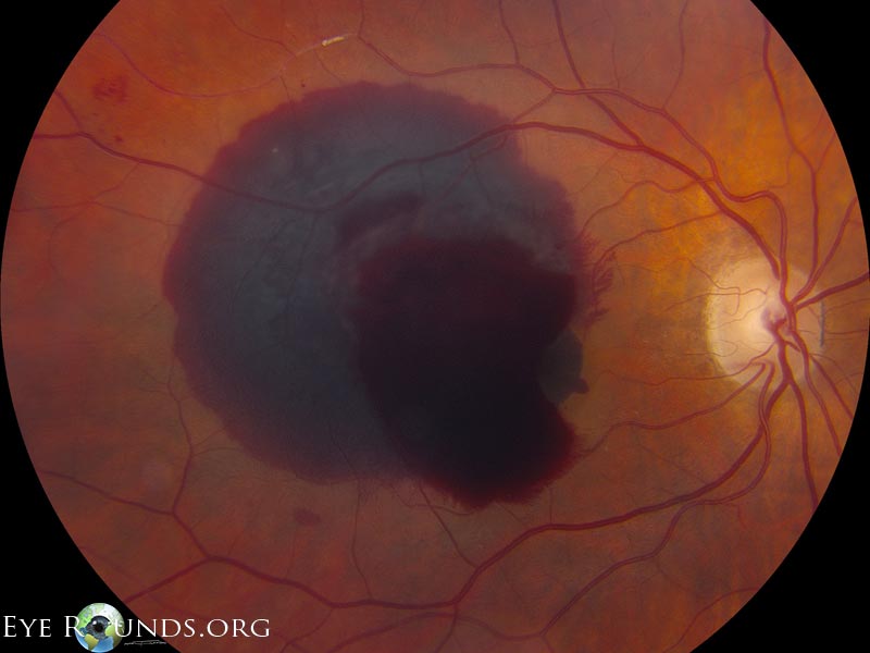 large subretinal macular hemorrhage with preretinal breakthrough in the right eye