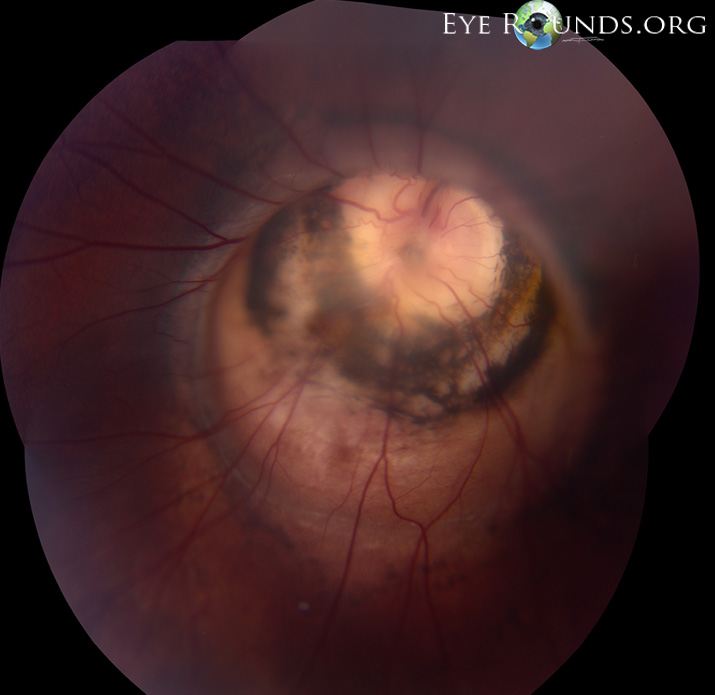 Morning Glory Disc Anomaly With Peripapillary Staphyloma :: The 