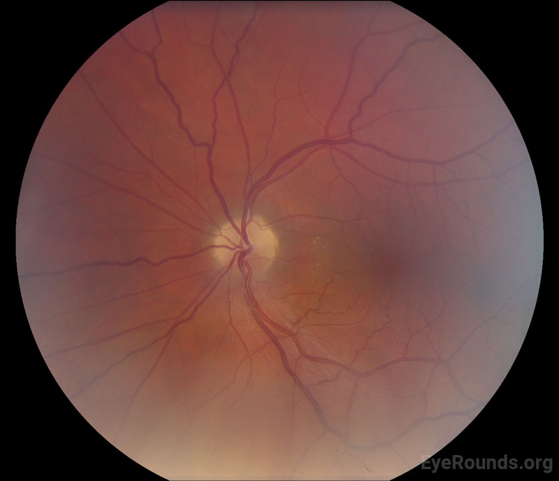 fundus OS NAION 6 months later