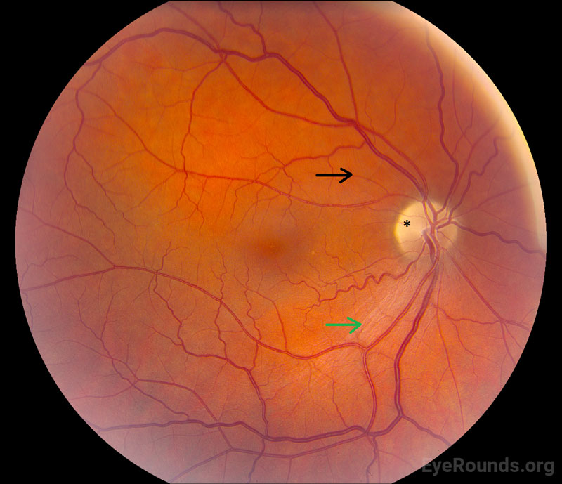 superior segmental optic disc (asterisk) pallor and loss of the RNFL bundle superiorly