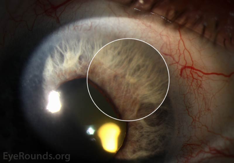 diffuse illumination of the right eye shows NVI as demonstrated by the fine, lacy blood vessels surrounding the pupillary margin