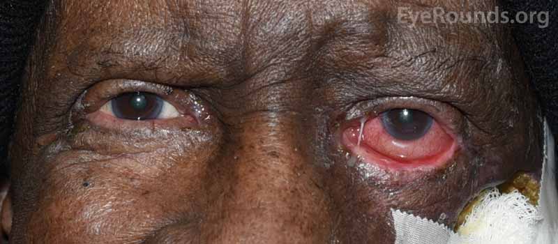 External photograph demonstrating the left upper eyelid position, exposure keratopathy, and diffuse injection of the left eye prior to receiving neurotoxin. 