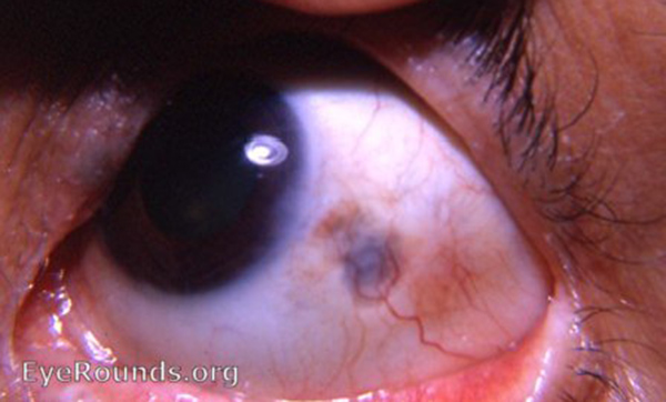 sclera: residual plaque of thinned sclera following nodular scleritis.
