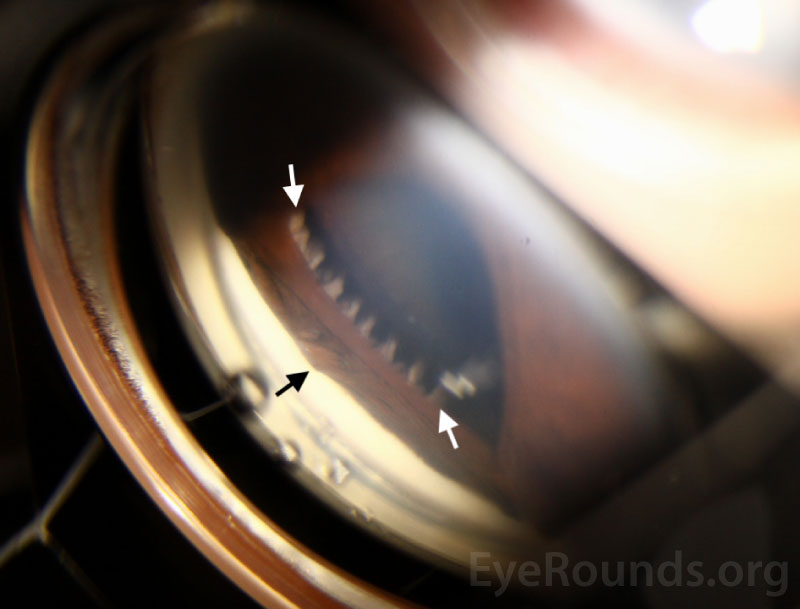  Gonioscopic photography of the right eye shows high peripheral anterior synechiae (PAS)