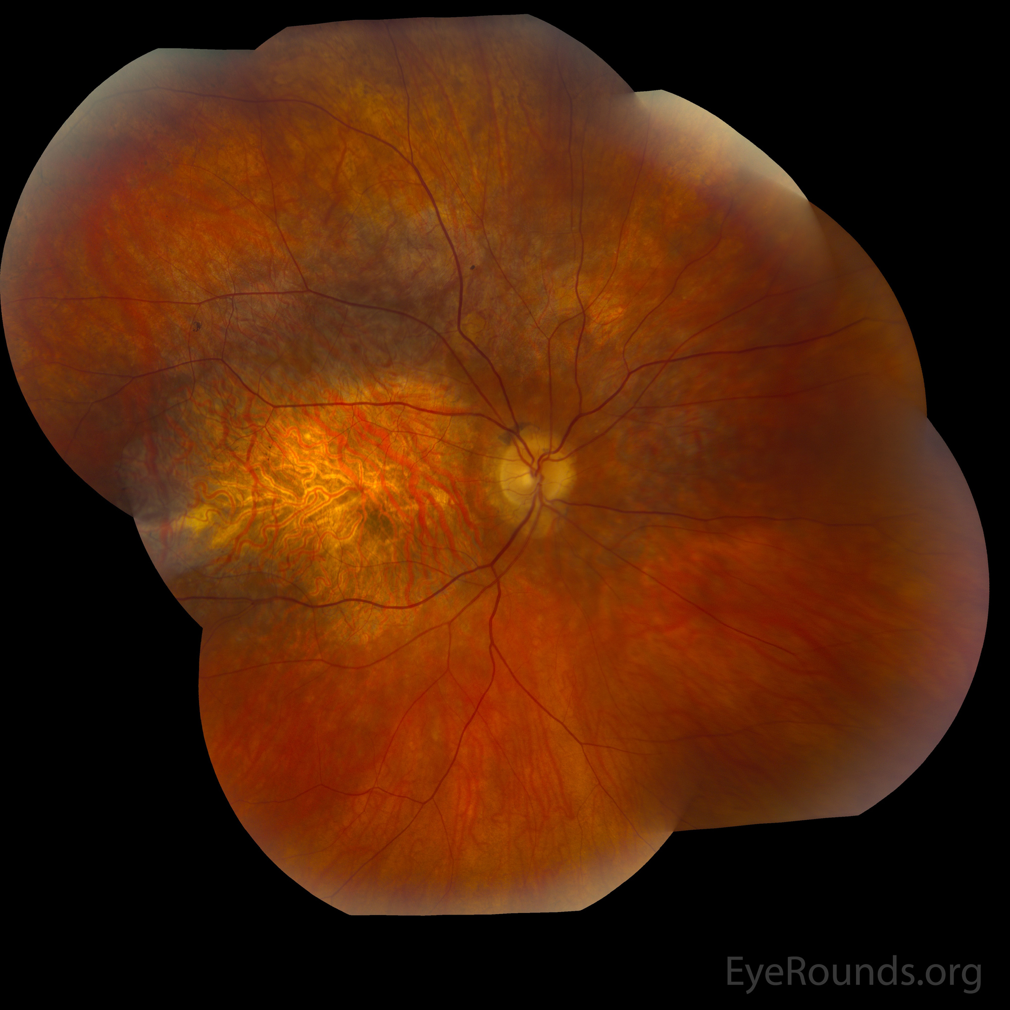 fundus montage OD with molecularly-confirmed pattern dystrophy
