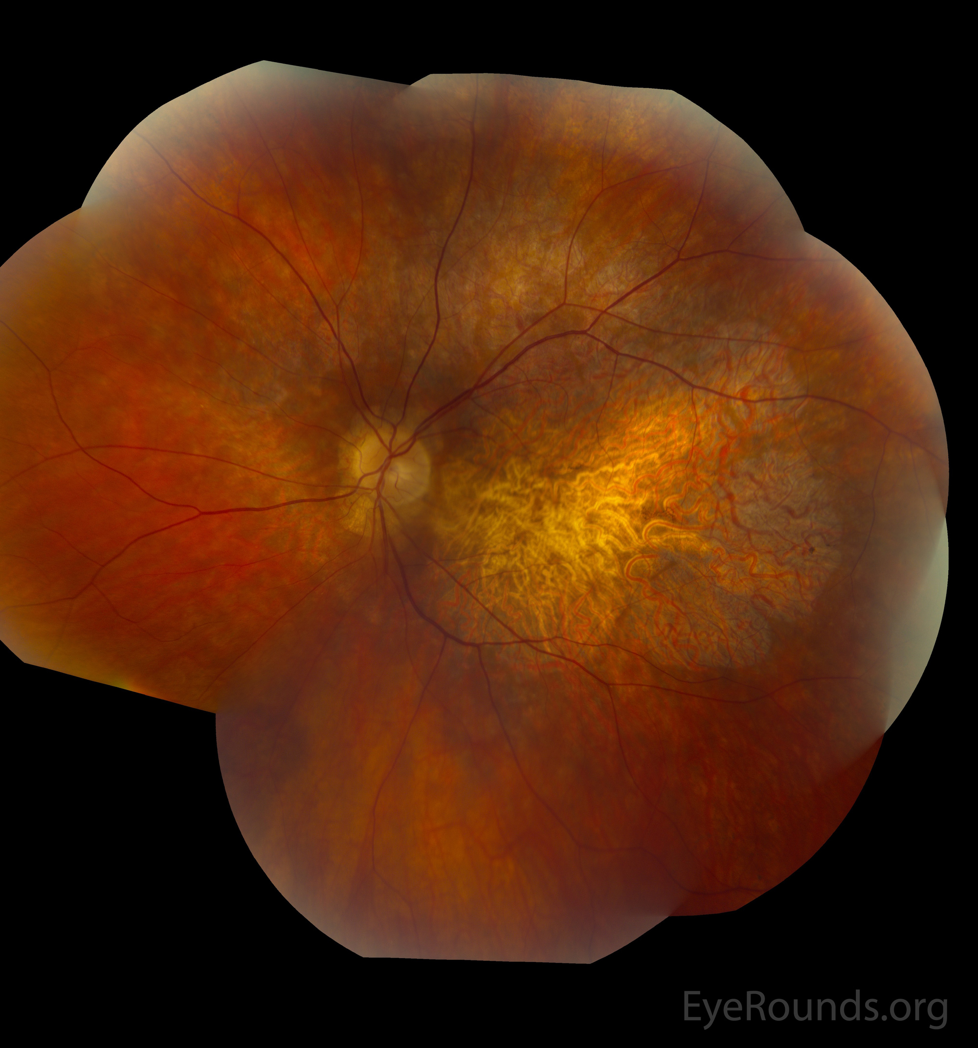 fundus montage OS with molecularly-confirmed pattern dystrophy