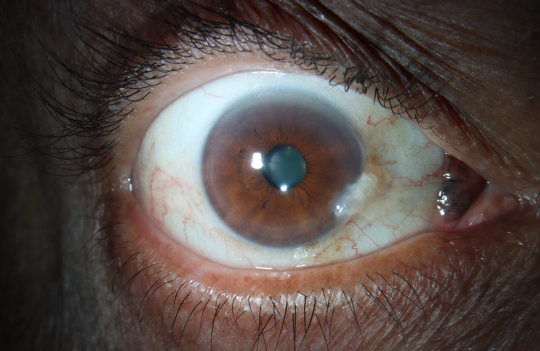 Dilated funduscopic examination showed severe, diffuse optic atrophy OD and bow-tie (band) optic atrophy OS