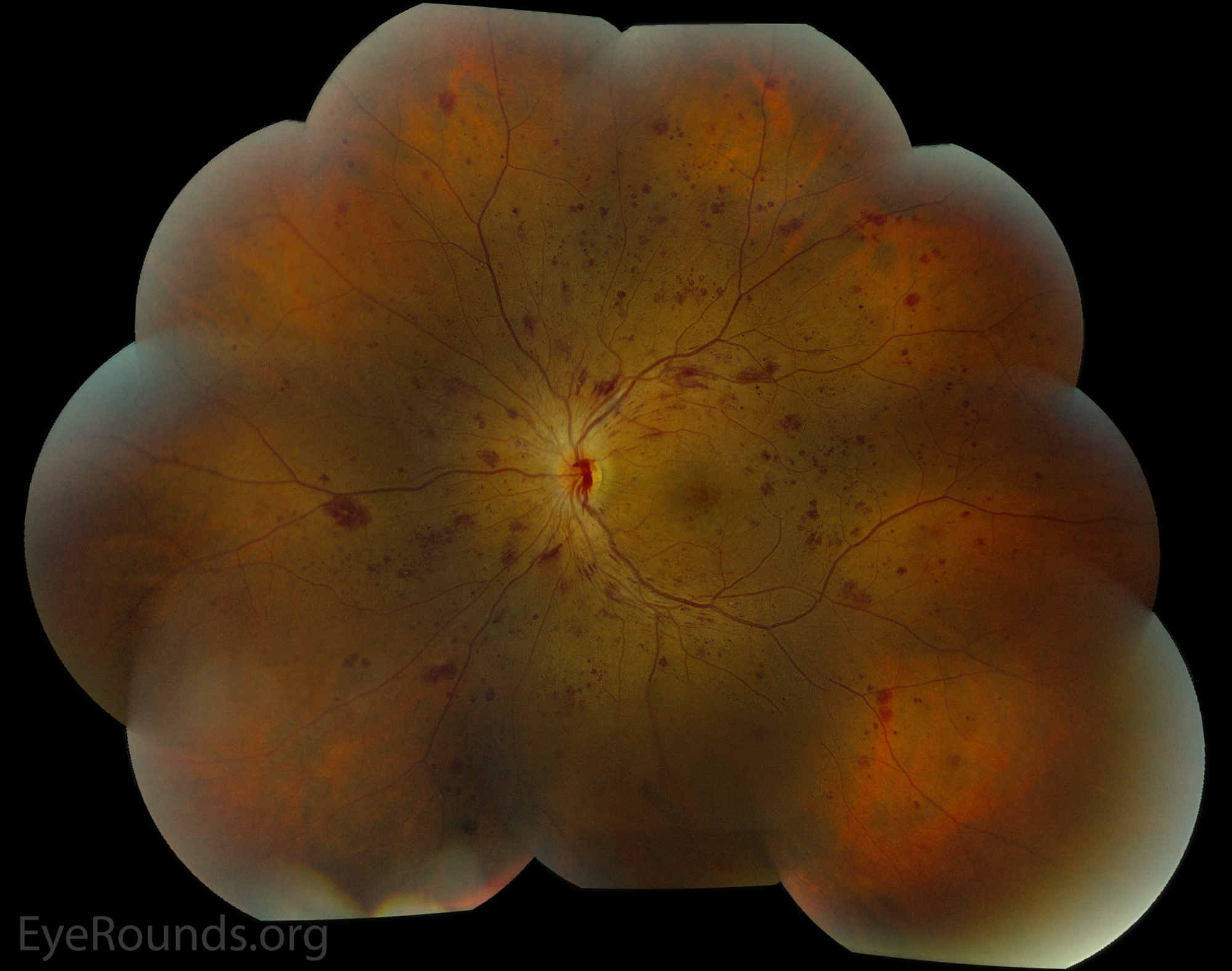 there is a pre-retinal hemorrhage overlying the optic nerve and tracking inferiorly