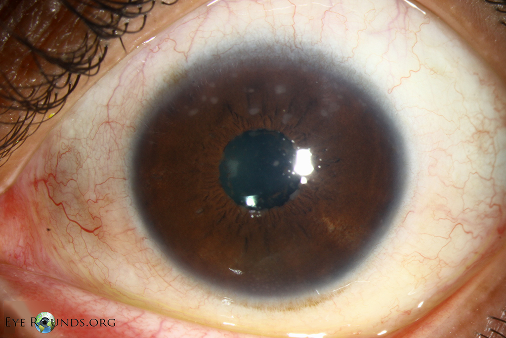 Mutton-fat keratic precipitates and iris granulomas in sarcoidosis straight view