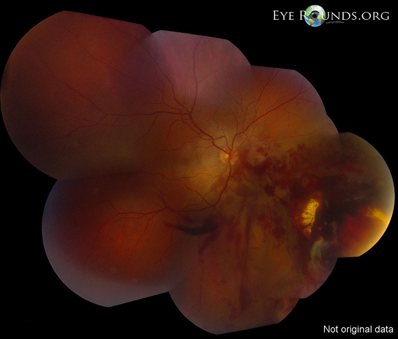fundus montage showed  inferonasal sclopetaria with associated intraretinal and pre-retinal hemorrhage