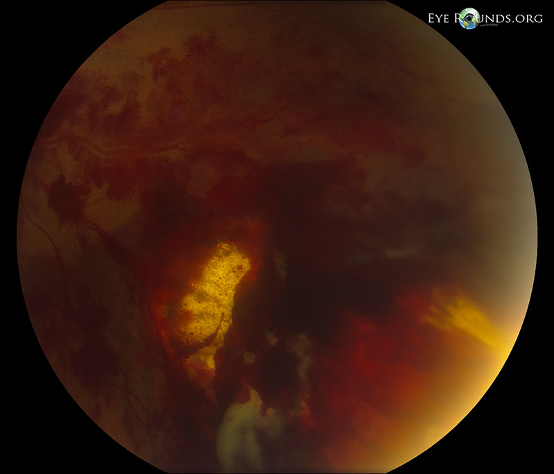 Dilated funduscopic examination showed  inferonasal sclopetaria with associated intraretinal and pre-retinal hemorrhage