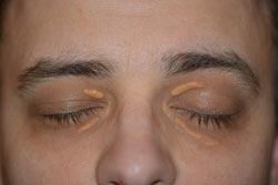 xanthelasma
