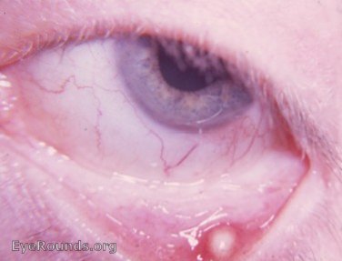 meibomian gland: abscess of meibomian gland; internal sty; internal hordeolum