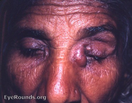 Dacryocystitis, chronic with abscess formation, OS