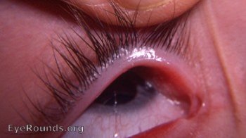 anatomical anomaly of caruncula lacrimalis