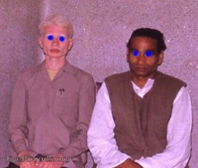 albinism in India patients- father normal, son albinism