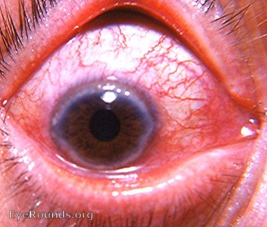 allergic corneal reaction