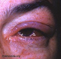 acute angular meibomitis ( meibomianitis ) with marked chemosis, lid edema, and pain OS