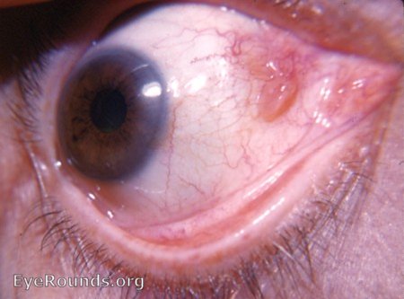 papillomatous anomaly of bulbar conjunctiva near plica semilunaris