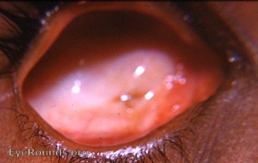 clinical anophthalmos