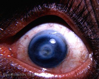 central corneal with a partial arcus senilis