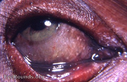 argyrosis/argyria - a second case