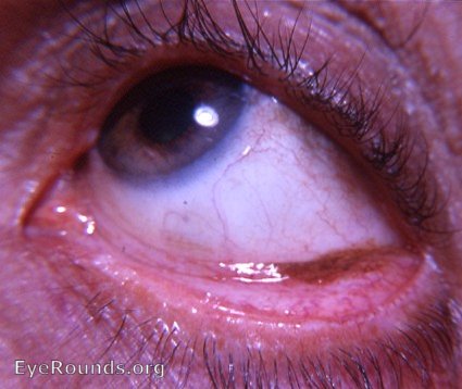 argyrosis/argyria - a second case