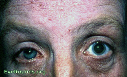 cataract: intumescent cataracta neurodermatica, i.e. a cataract associated with atopic dermatitis