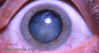 cataract: intumescent cataracta neurodermatica, i.e. a cataract associated with atopic dermatitis