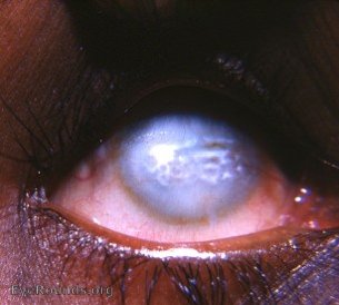 interstitial keratitis with band-shaped keratopathy