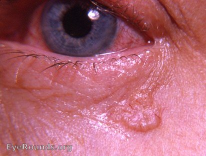 case basal cell carcinoma