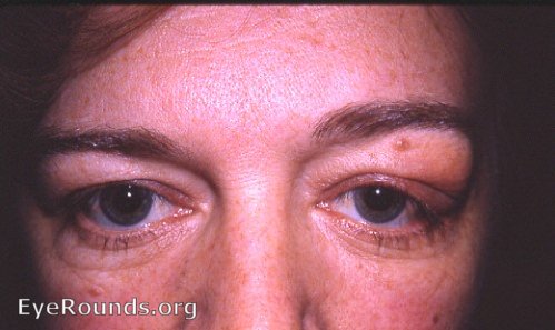 benign lymphocytic infiltration of lacrimal gland OS