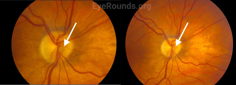 Fundus photo demonstrating a Bergmeister papilla