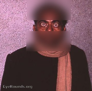 Bilateral exophthalmus with Graves' Disease ( hyperthyroidism )'