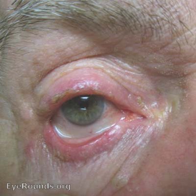 blepharitis and meibomian gland dysfunction