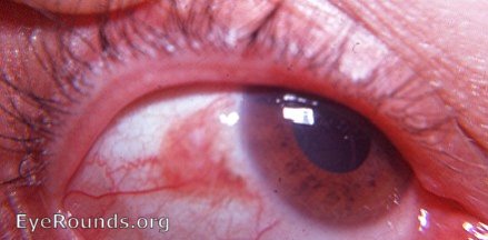 dyskeratosis/ Bowen's disease/ carcinoma in situ - with leukoplakia: an earlier photo of this case is in this Atlas. This second photo provides a better view of the lesion