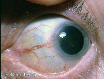 Limbal dyskeratosis