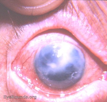 bullous keratopathy following intracapsular cataract surgery