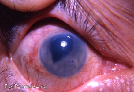 bullous keratopathy following intracapsular cataract surgery -