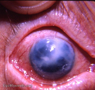 bullous keratopathy following intracapsular cataract surgery