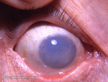 bullous keratopathy following intracapsular cataract surgery -