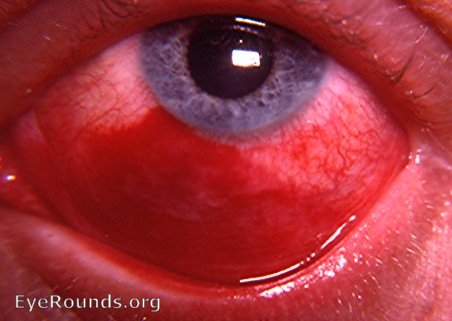 traumatic subconjunctival hemorrhage