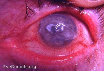 burns of lid margin and superficial cornea