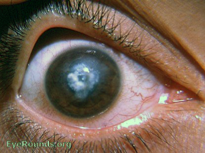 scar of healed corneal ulcer with calcification