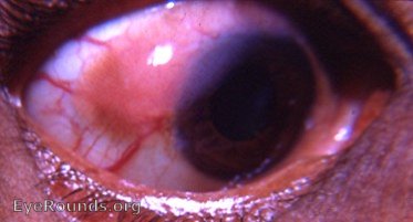 carcinoma of the conjunctiva