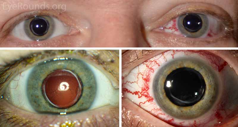 Figure 1. External photography and slit lamp examination of both eyes.  Upper image: External photo demonstrating the difference in appearance between the right (OD) and left eye (OS). Left image: The right eye had a completely normal exam. Right image: Dilated corkscrew vessels extended to the limbus OS.The patient also had periorbital edema on the left with mild abduction deficit and proptosis.